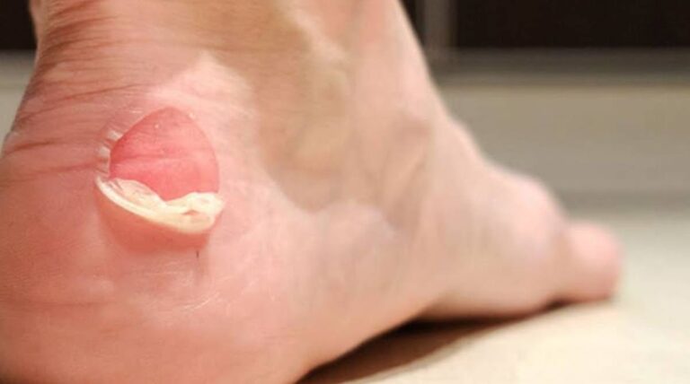 Cómo prevenir y tratar las ampollas en los pies