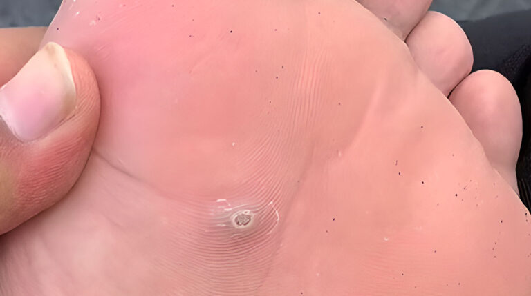 ojo de gallo